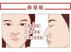 法令纹严重、凸嘴这可能是鼻基底凹陷所致