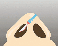 你知道鼻修复手术难度为什么比初次鼻更大吗？